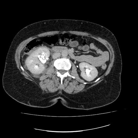 AAST kidney injury scale | Radiology Reference Article | Radiopaedia.org