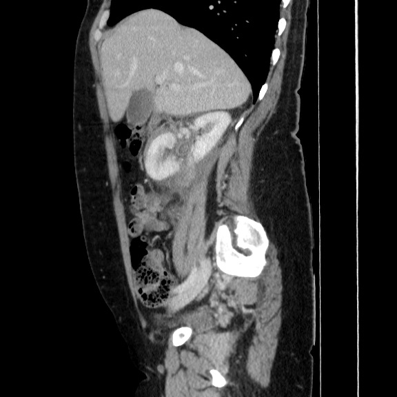 Renal trauma - AAST grade IV injury | Image | Radiopaedia.org