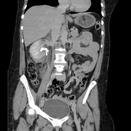 Renal trauma - AAST grade IV injury | Image | Radiopaedia.org