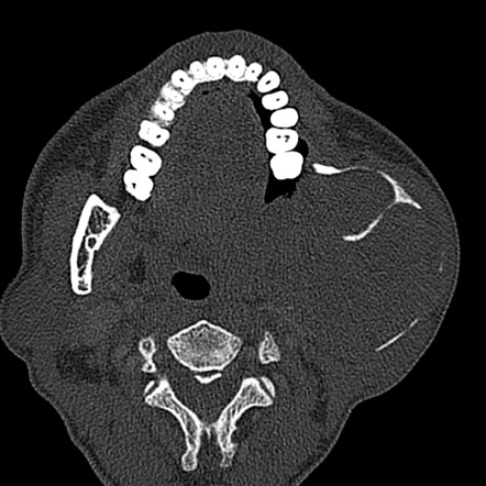 Ameloblastoma | Radiology Case | Radiopaedia.org