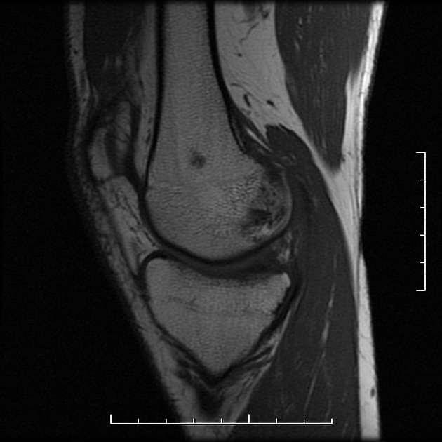 Solitary Lucent Lesion Osteoid Osteoma Vs Enchondroma Radiology Case Radiopaedia Org