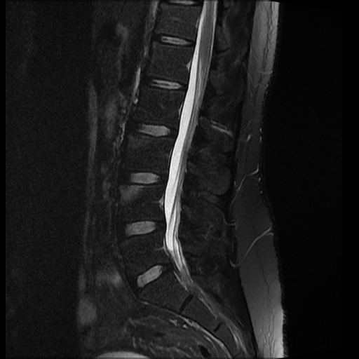 Ankylosing spondylitis - shiny corner sign | Image | Radiopaedia.org