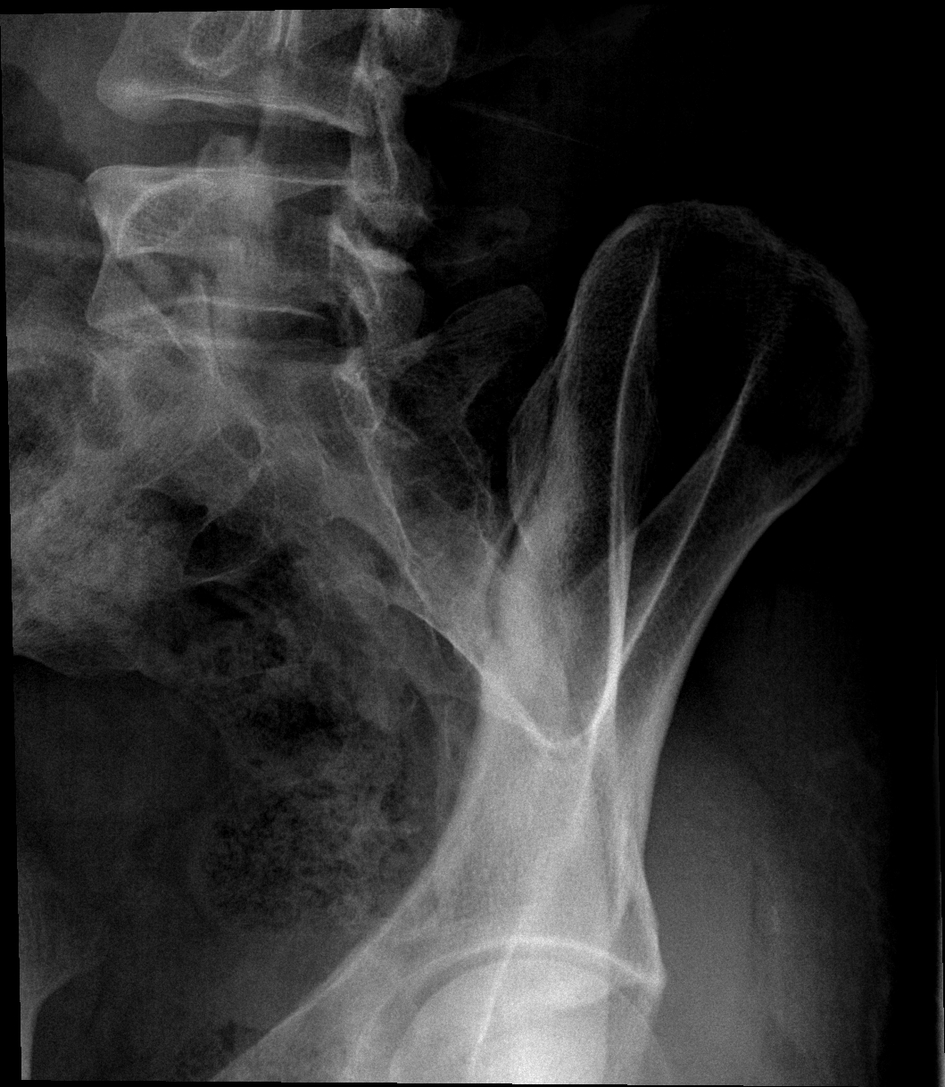 Ankylosing spondylitis - shiny corner sign | Image | Radiopaedia.org