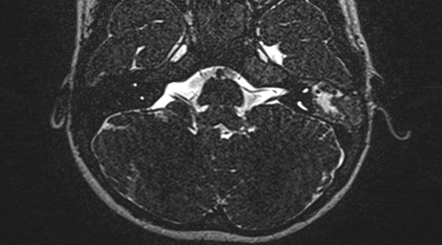 Congenital facial palsy Radiology Reference Article