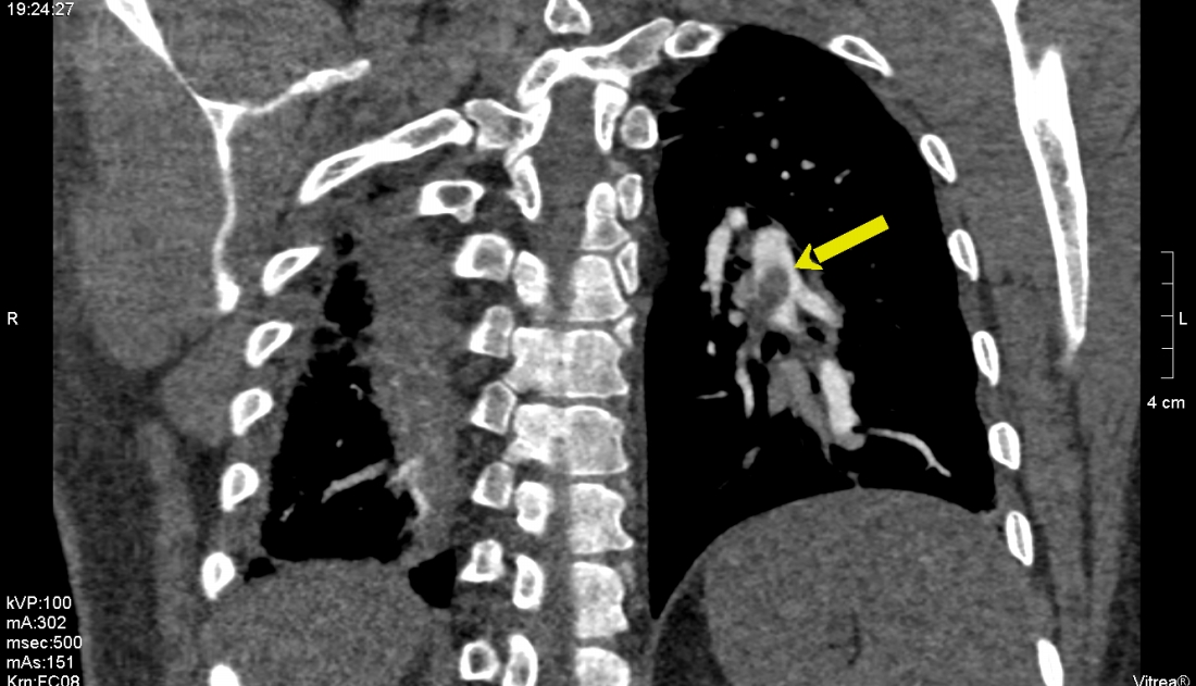 Saddle Pulmonary Embolism Image