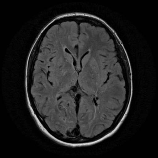 Klippel-Trenaunay-Weber syndrome - CNS manifestations | Image ...