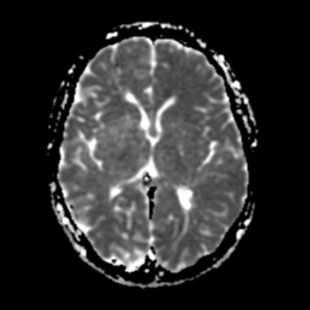 Klippel-Trenaunay-Weber syndrome - CNS manifestations | Image ...