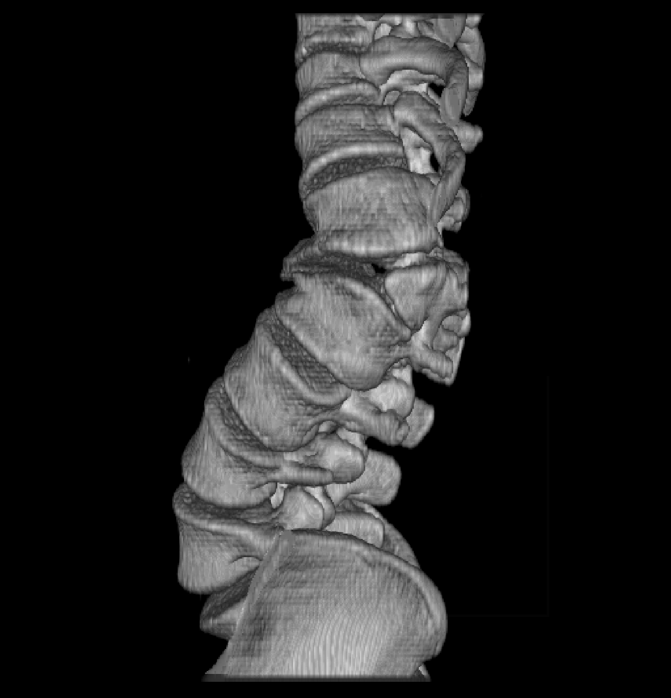 Hemivertebra With Congenital Scoliosis Radiology Case Radiopaedia Org