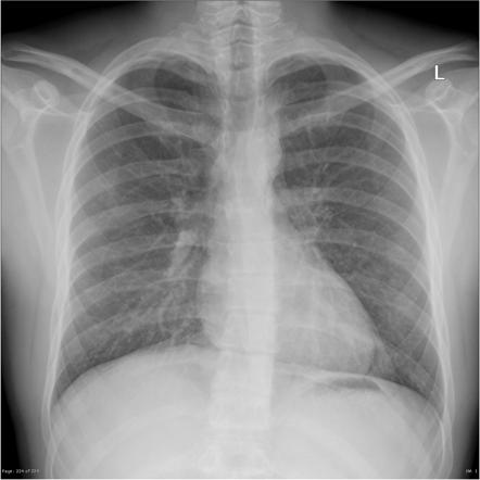 Pneumomediastinum | Radiology Case | Radiopaedia.org