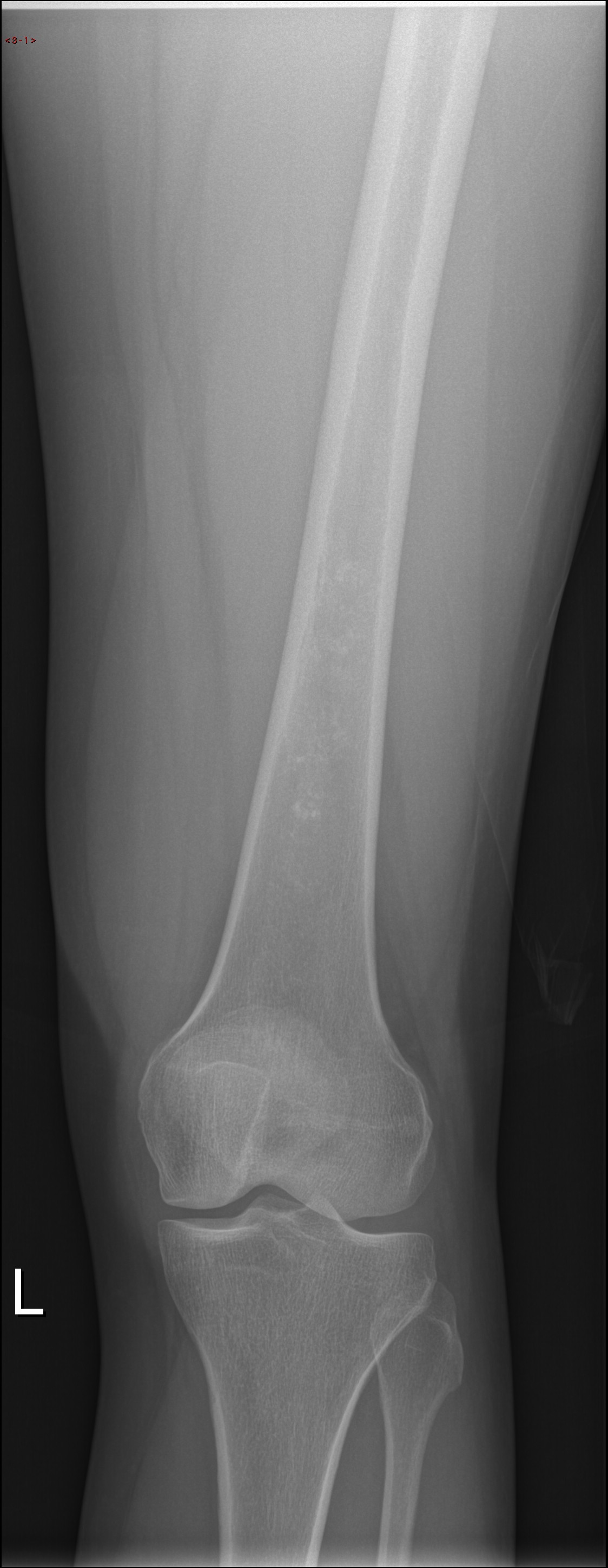 Enchondroma - distal femur | Image | Radiopaedia.org