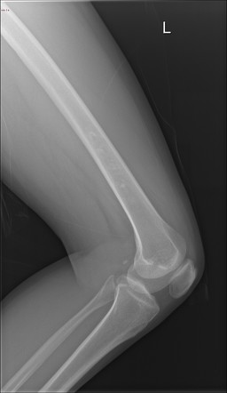 Enchondroma - distal femur | Image | Radiopaedia.org