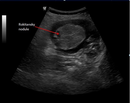 Ovarian dermoid | Image | Radiopaedia.org