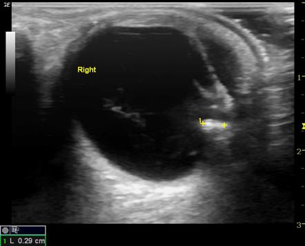 Ocular foreign body | Radiology Reference Article | Radiopaedia.org