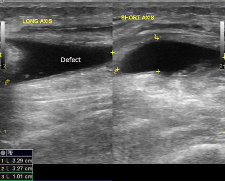 Vastus lateralis muscle tear | Image | Radiopaedia.org