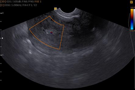 Feeding Artery Sign (endometrial Polyp) | Radiology Reference Article ...