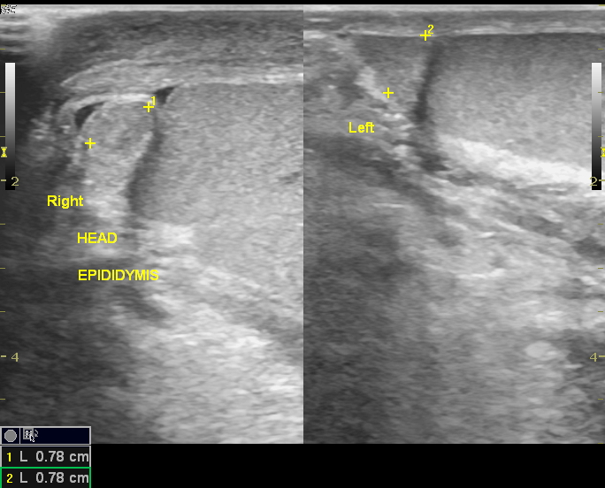 Scrotal Cellulitis Image