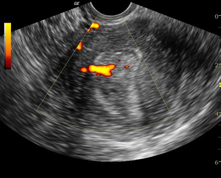 Feeding artery sign (endometrial polyp) | Radiology Reference Article ...