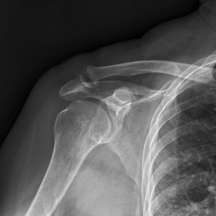 Coracoacromial ligament ossification | Radiology Case | Radiopaedia.org