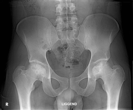 Sagging Rope Sign (perthes Disease) 