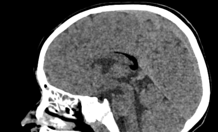 Pericallosal lipoma | Image | Radiopaedia.org