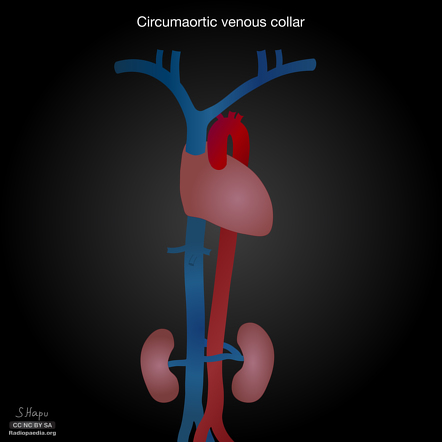 Circumaortic left renal vein | Radiology Reference Article