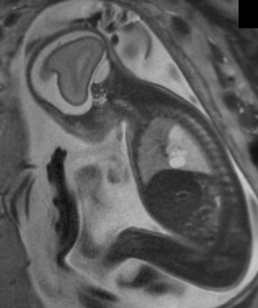 Congenital Pulmonary Airway Malformation Cpam In A Fetus Image Radiopaedia Org