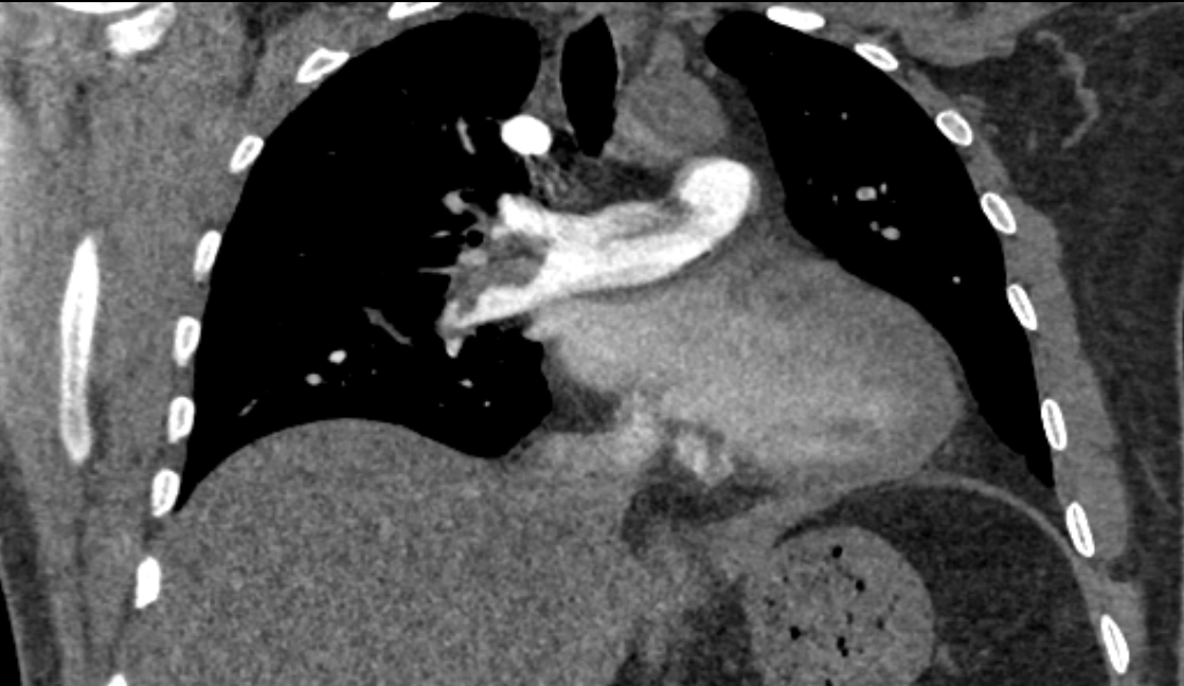 Saddle pulmonary embolism | Image | Radiopaedia.org