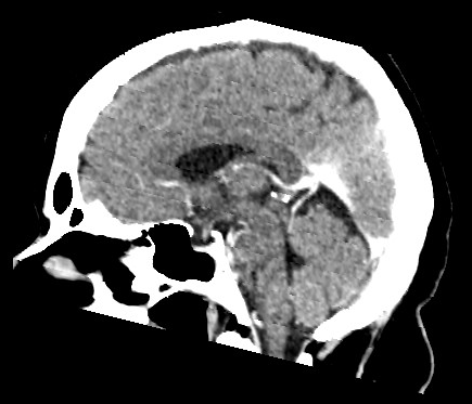 Azygos anterior cerebral artery | Image | Radiopaedia.org