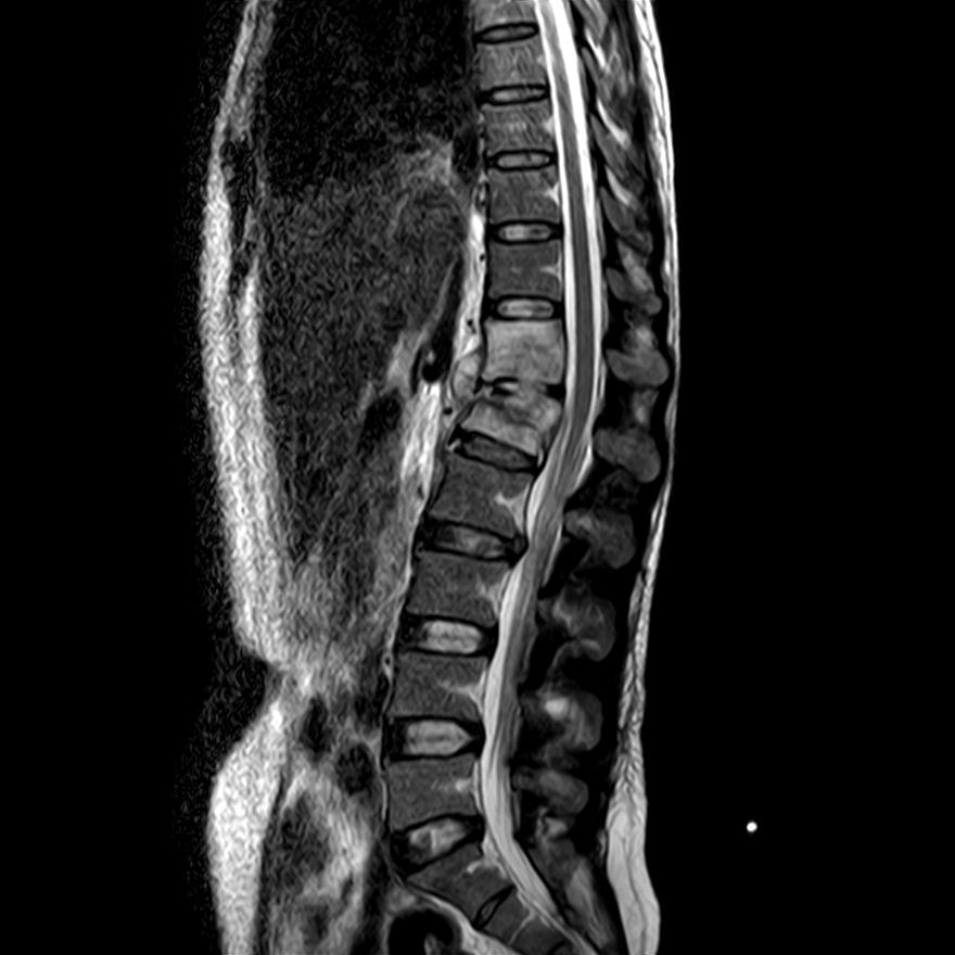 Spondylodiscitis And Right Psoas Abscess | Image | Radiopaedia.org