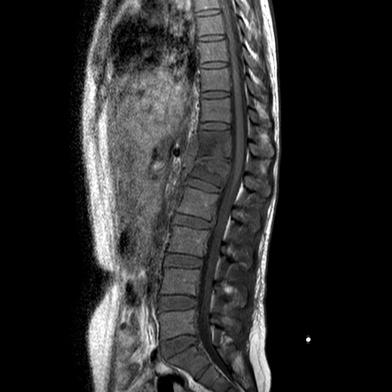 Spondylodiscitis and right psoas abscess | Image | Radiopaedia.org