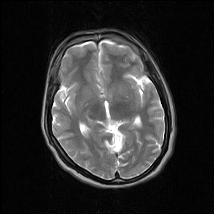 Septo Optic Dysplasia With Schizencephaly Image