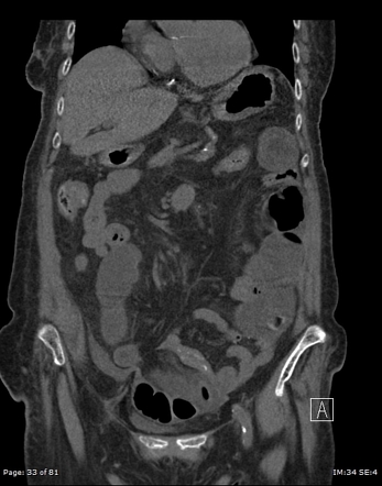 Internal hernia | Radiology Reference Article | Radiopaedia.org