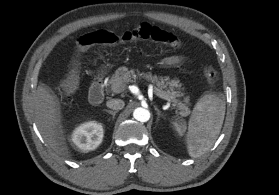 Celiac Artery Dissection Image