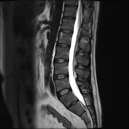 Ankylosing spondylitis (bilateral sacroiliitis and romanus lesion ...