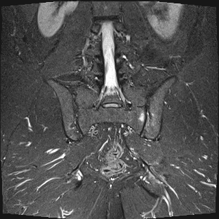 Ankylosing spondylitis (bilateral sacroiliitis and romanus lesion ...