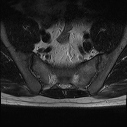 Ankylosing spondylitis (bilateral sacroiliitis and romanus lesion ...