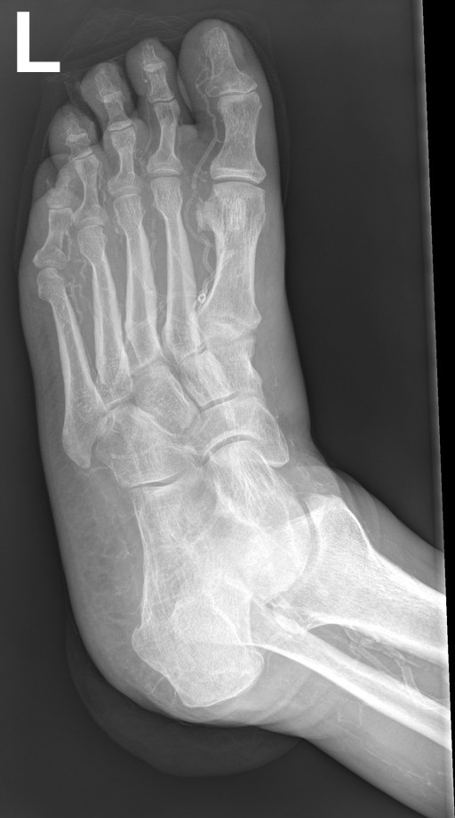 Vascular Calcification On Foot X Ray Flash Sales | emergencydentistry.com