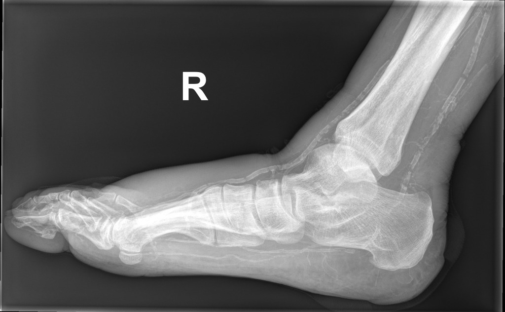 Vascular calcification | Image | Radiopaedia.org