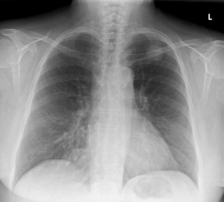 Left Upper Lobe Squamous Cell Carcinoma 