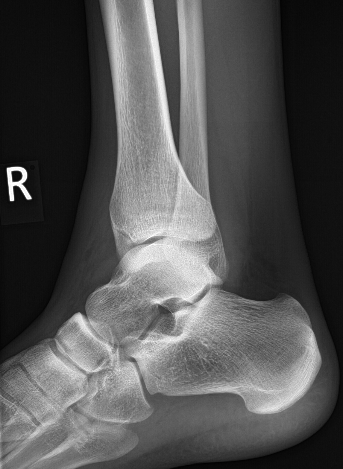 Non-displaced medial malleolar fracture | Image | Radiopaedia.org