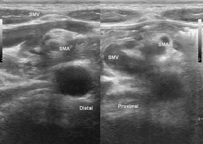 Intestinal malrotation | Image | Radiopaedia.org