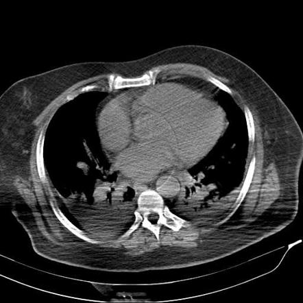 Beam hardening | Radiology Reference Article | Radiopaedia.org