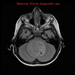 Ependymoma | Image | Radiopaedia.org