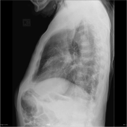 Right upper lobe collapse | Radiology Reference Article | Radiopaedia.org