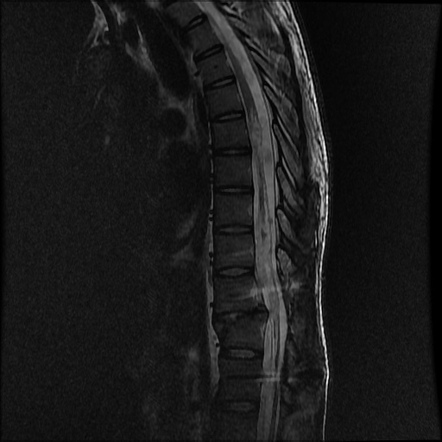 Traumatic spinal cord injury | Radiology Reference Article