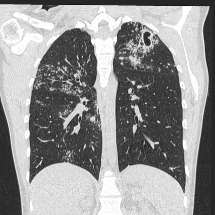 Tuberculosis (summary) | Radiology Reference Article | Radiopaedia.org