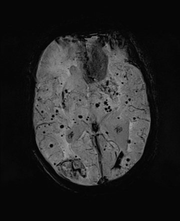 Cerebral Amyloid Angiopathy | Radiology Case | Radiopaedia.org