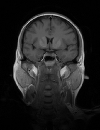 Non-ketotic hyperglycemic hemichorea | Radiology Reference Article ...