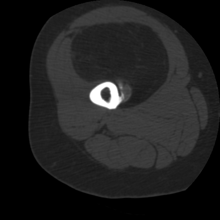 Parosteal lipoma | Image | Radiopaedia.org