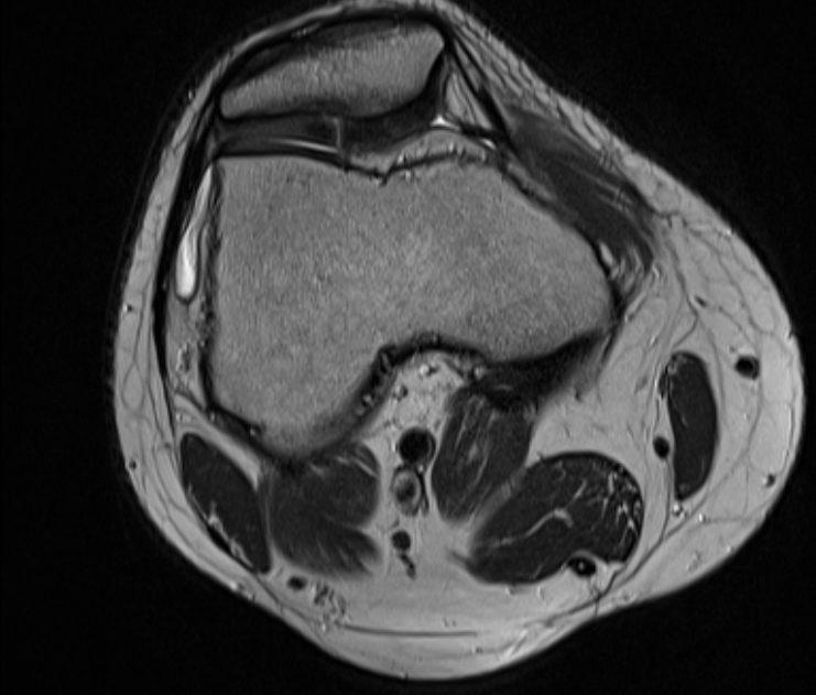 Chondromalacia Patellae Image